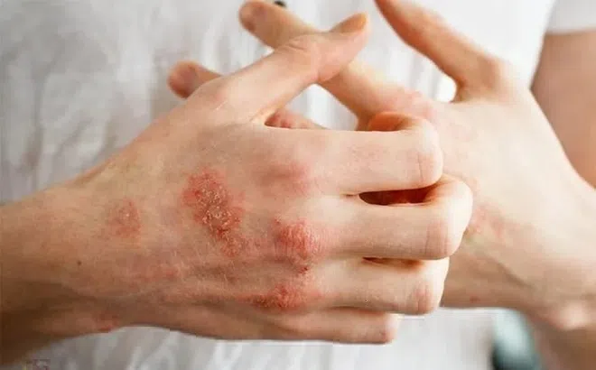 6 lưu ý phòng bệnh da liễu trong mùa mưa