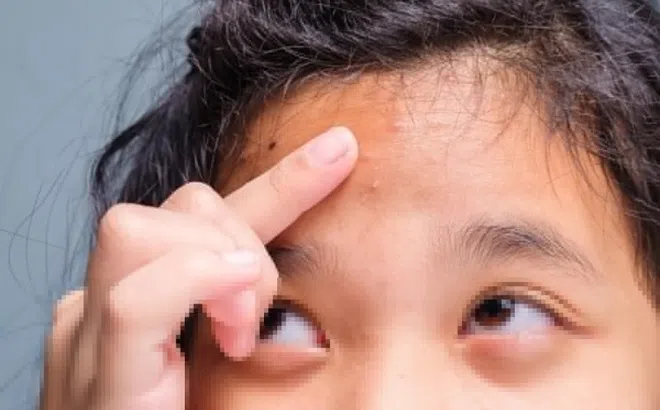 Cần làm gì khi trẻ bị mụn trứng cá?
