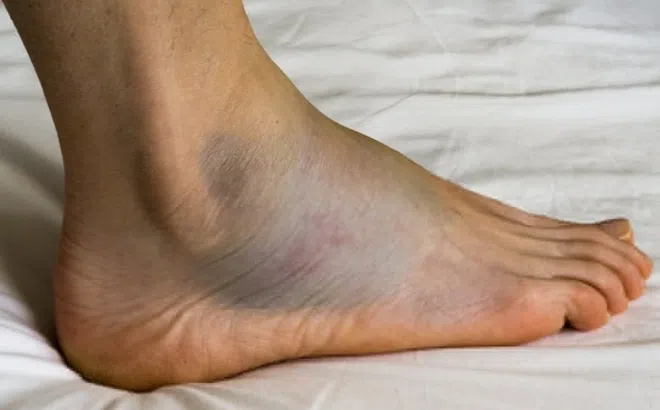 Những dấu hiệu cảnh báo suy tim dễ bị bỏ qua