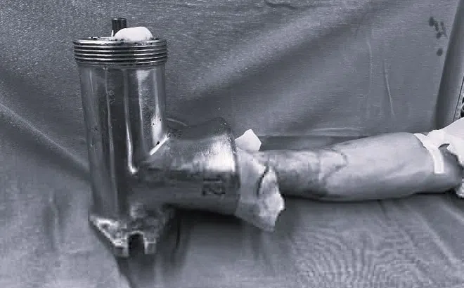 Bàn tay dập nát do bị cuốn vào máy xay thịt