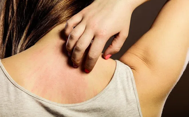 Vì sao luôn cảm thấy ngứa dù đã tắm sạch sẽ