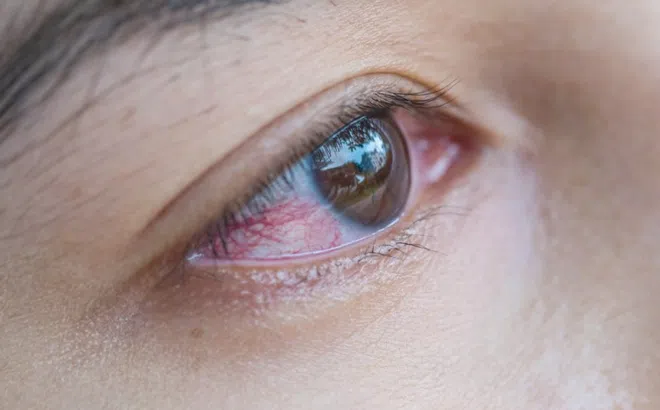 Dấu hiệu chứng tỏ bạn nhiễm giun đũa chó mèo