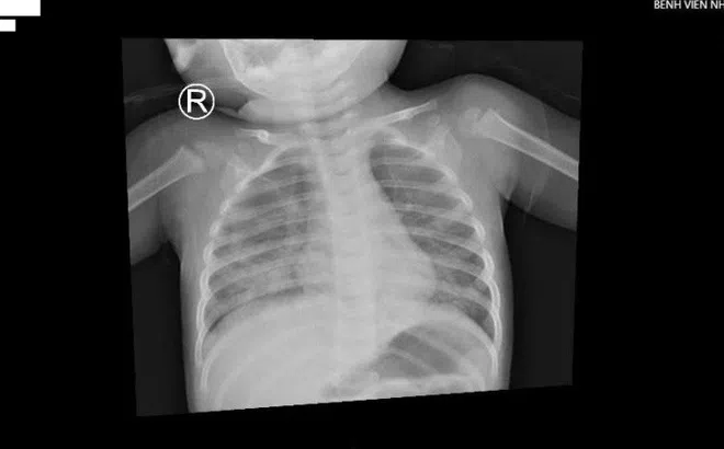 Bé trai 1 tuổi ở TP.HCM nhập viện vì hít dầu để thắp đèn