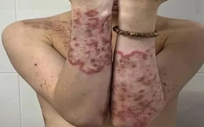 Tự ý điều trị ngứa, nam thanh niên bị nấm mọc toàn thân
