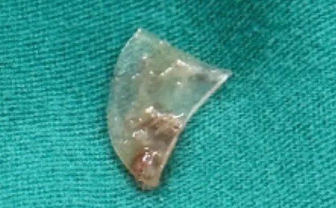 Bé gái ở TP.HCM khó thở suốt 4 tháng, gia đình bất ngờ khi biết lý do