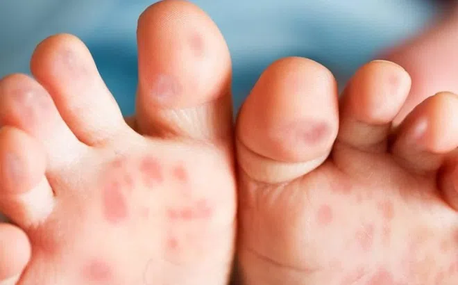 4 nguyên tắc ăn uống khi trẻ bị tay chân miệng