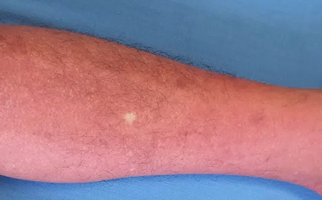 Người lớn mắc sốt xuất huyết có bị biến chứng nguy hiểm không?