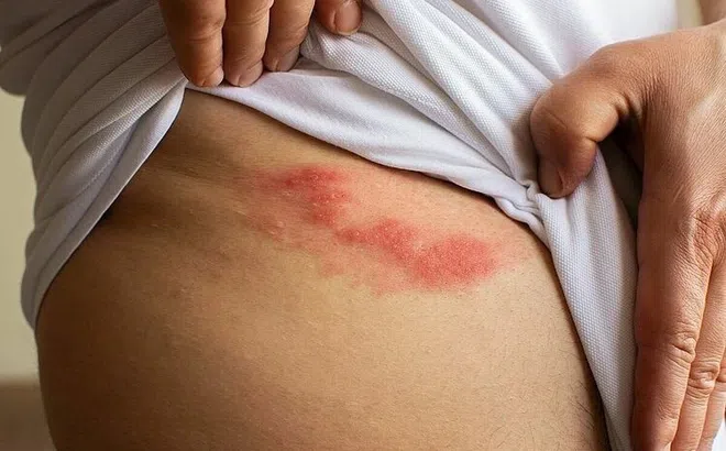 Căn bệnh 'đau hơn đau đẻ', có thể mắc nhiều lần trong đời