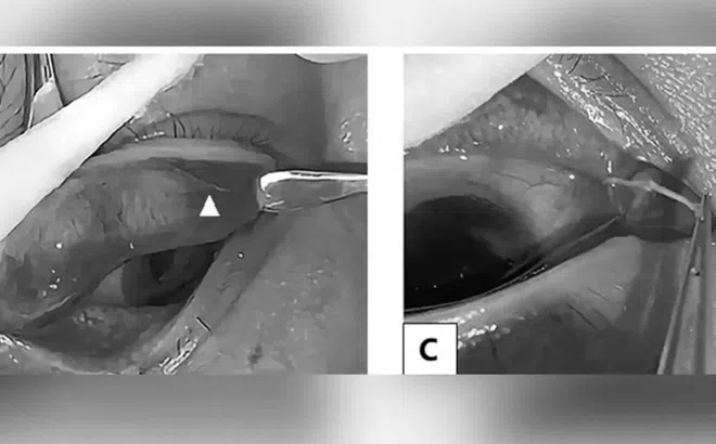 Bác sĩ phát hiện giun sống dưới mí mắt của một phụ nữ