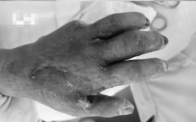 Suýt mất bàn tay chỉ vì một vết ngứa nhỏ