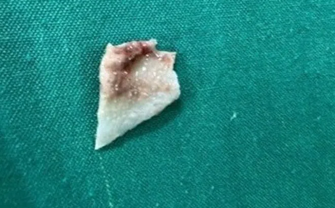 Bé gái phải cấp cứu nội soi vì sự cố khi ăn cháo