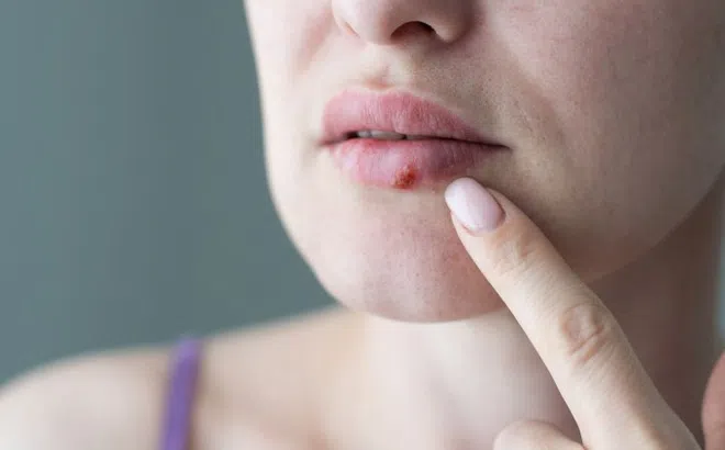 5 thay đổi trên mặt có thể liên quan bệnh đường tình dục