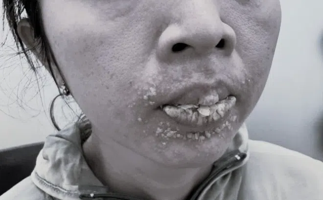 Môi bong tróc như mào gà vì làm đẹp cấp tốc đón Tết