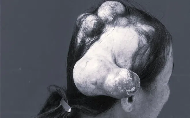 Bệnh ung thư khiến người phụ nữ 'mọc sừng' chi chít trên đầu