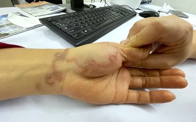 Sán bò lổm ngổm dưới da người phụ nữ nuôi chó