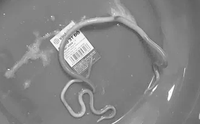 Giun bám kín ruột vì chủ quan với món ăn quen thuộc