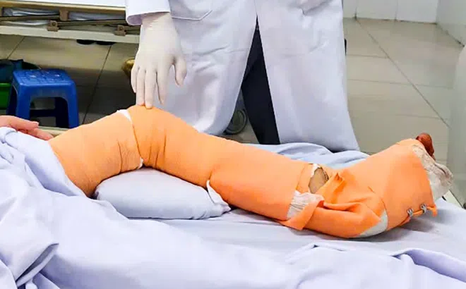 Người lái tàu biển suýt bị cắt bỏ chân vì ‘vi khuẩn ăn thịt người’