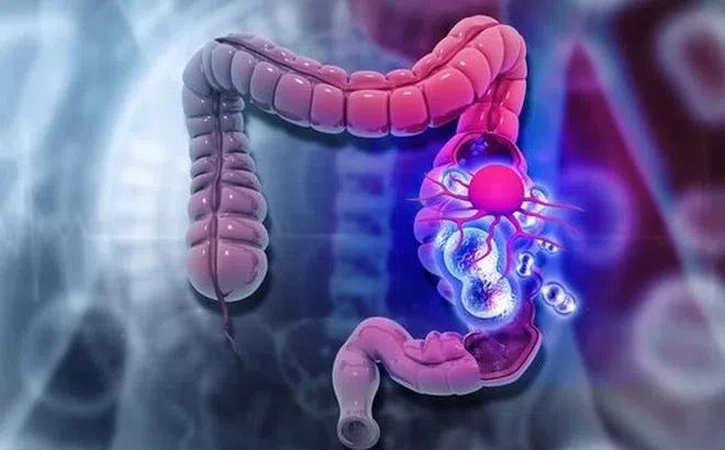 Một bệnh ung thư đang trẻ hóa, số ca tăng lên từng ngày