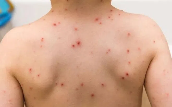 Bệnh sởi có thể bị mấy lần trong đời, làm sao để phòng ngừa?