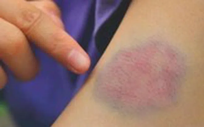 Bỗng dưng xuất hiện vết bầm tím, có thể là dấu hiệu rối loạn tiểu cầu