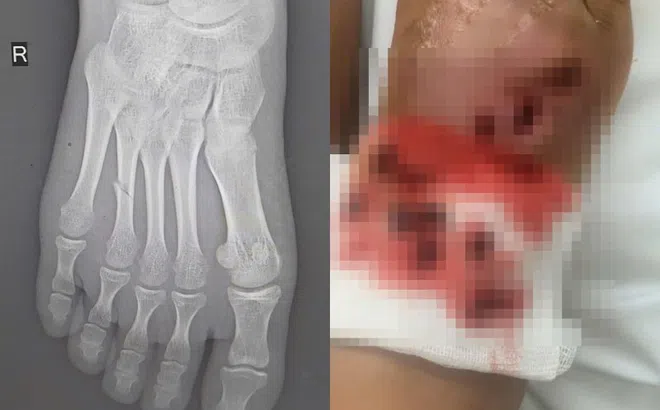 Bé gái suýt mất chân vì bó thuốc nam chữa gãy xương tại nhà