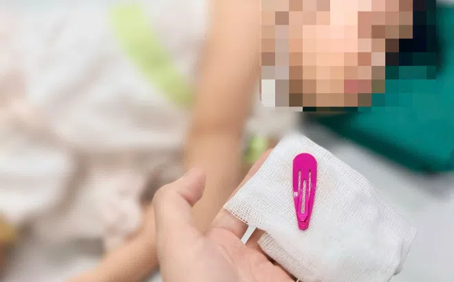 Bé 21 tháng tuổi phải nhập viện vì kẹp tóc nằm trong dạ dày