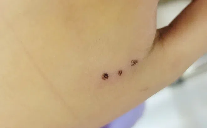 Bé 10 tuổi nhập viện vì bị chuột cắn