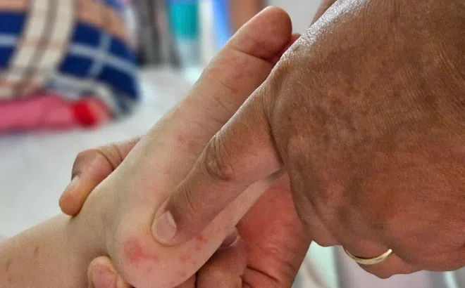 Tay chân miệng vào mùa, phụ huynh cần làm gì để bảo vệ con?