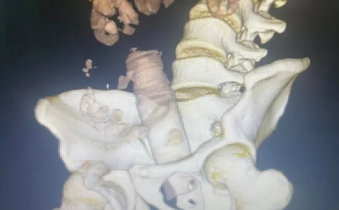 Tự chế đồ chơi tình dục, nam thanh niên nhập viện vì dị vật 'mắc kẹt'