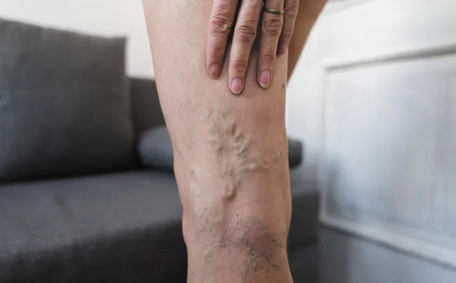 Biến chứng nguy hiểm của bệnh giãn tĩnh mạch