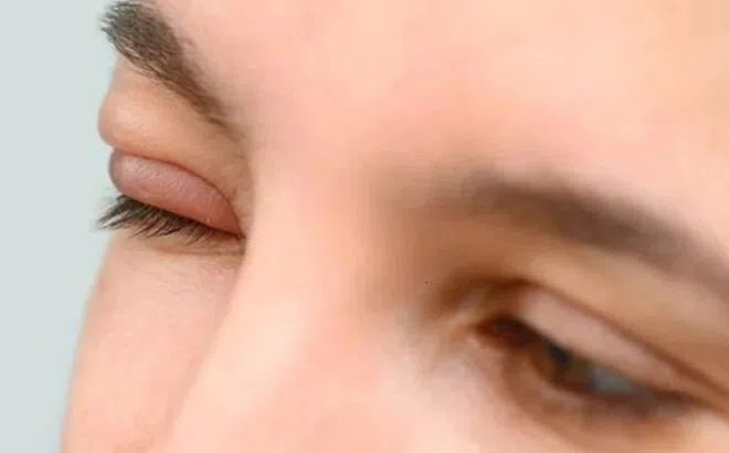 Nốt sưng nhỏ ở mắt khi nào có thể thành biến chứng lớn?
