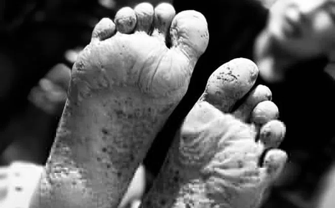 Đôi bàn chân lở loét của người dân vùng lũ Nghệ An gây 'bão mạng'