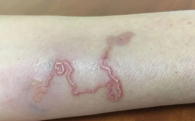 Món khoái khẩu khiến người đàn ông nhiễm cả 2 loại ký sinh trùng