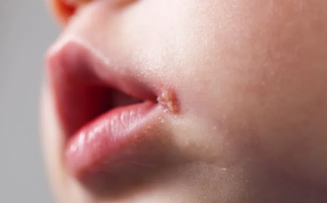 Nhiễm HSV ở trẻ sơ sinh