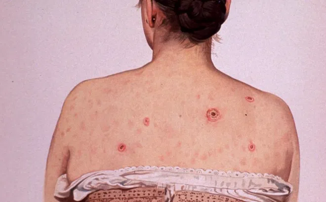 Bệnh giang mai ngày càng phức tạp