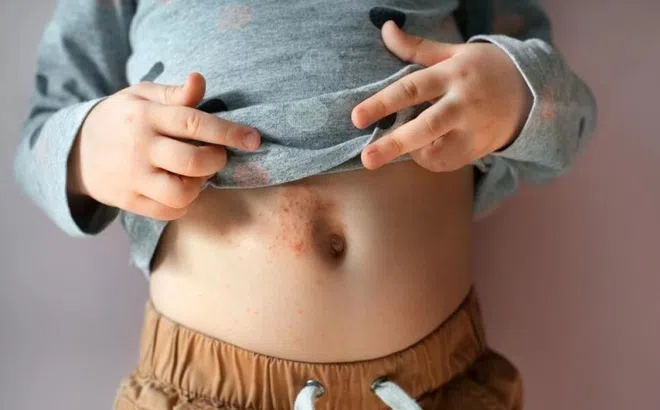 Dấu hiệu cảnh báo bệnh ghẻ ở trẻ