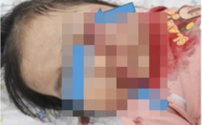 Một giây sơ suất, bé gái ngồi trước xe máy phải đi cấp cứu