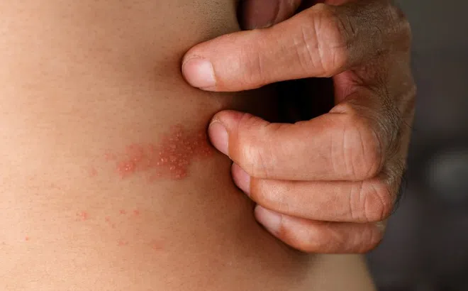 Dấu hiệu chứng tỏ bạn có thể mắc giời leo