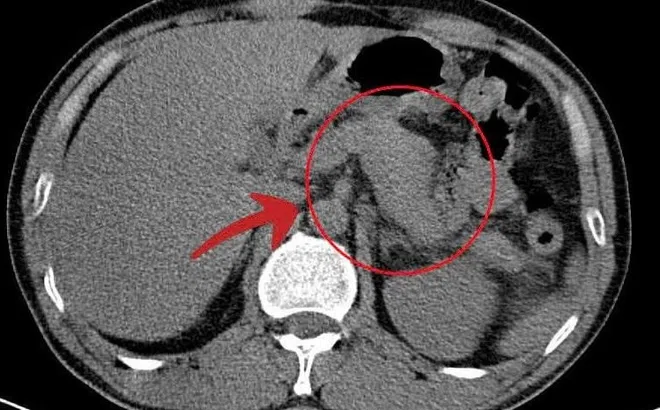 Người đàn ông gánh hậu quả vì uống rượu mỗi ngày suốt 5 năm