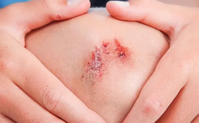 Căn bệnh nguy hiểm chỉ từ vết thương nhỏ