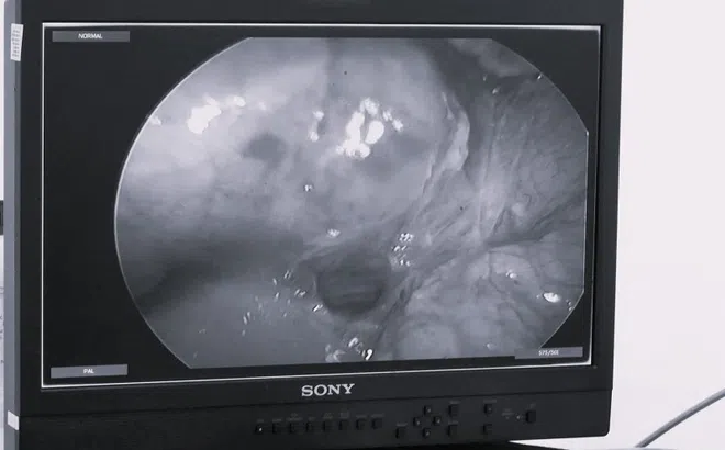 Thủng dạ dày vì thói quen nhiều người mắc phải khi đau