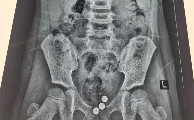 Bé gái chảy dịch âm đạo kéo dài vì nguyên nhân khó ngờ