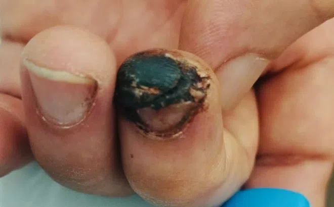 Vì sao uốn ván nguy hiểm?