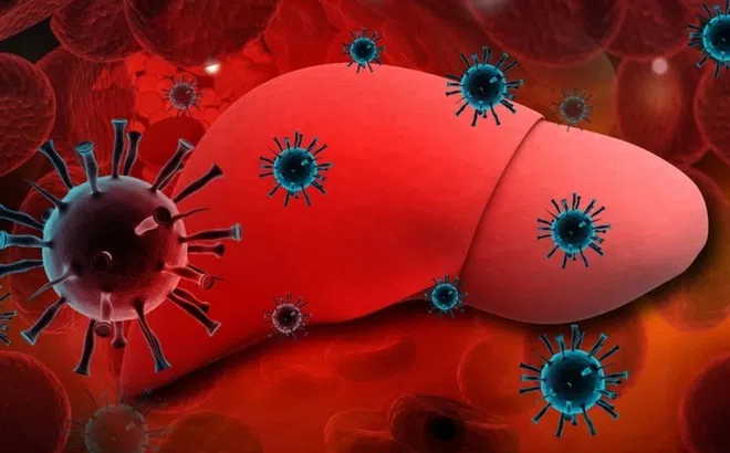 Căn bệnh phổ biến dễ gây ung thư gan, bác sĩ chỉ cách nhận biết