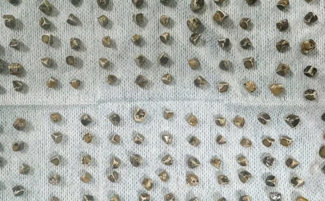 Đau bụng đi khám, người phụ nữ sốc khi bác sĩ lấy ra 130 viên sỏi mật