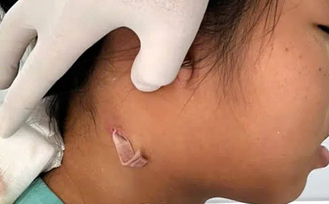 Chủ quan khi làm vườn, người đàn ông nhiễm 'khuẩn ăn thịt người'