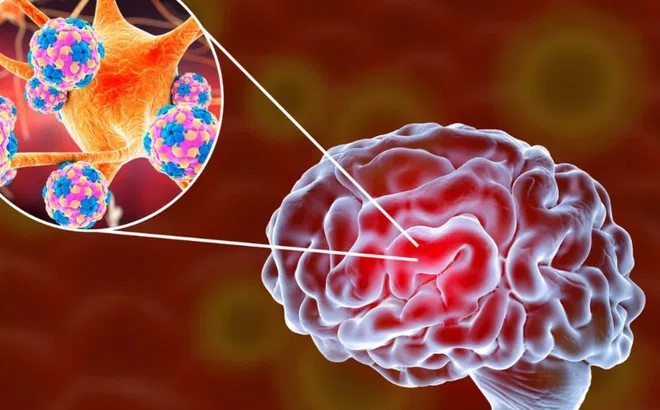 Nhận biết sớm các biểu hiện viêm màng não