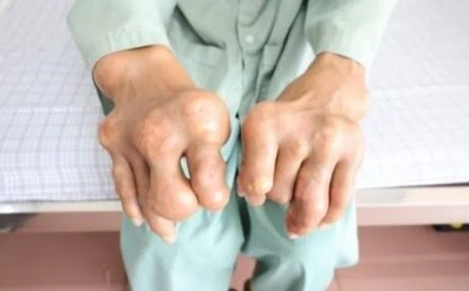 Đôi bàn tay gây ám ảnh của người đàn ông chủ quan với bệnh