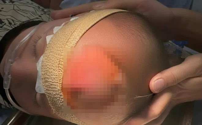 Từ nốt mẩn nhỏ đến áp xe trán, bác sĩ chỉ ra sai lầm thường gặp