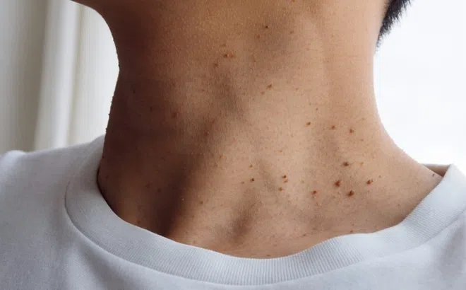 Dấu hiệu cảnh báo kháng insulin dễ thấy ngay trên mặt và da